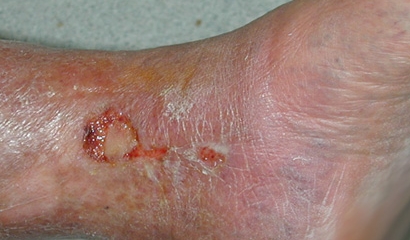 Ulcera Venosa